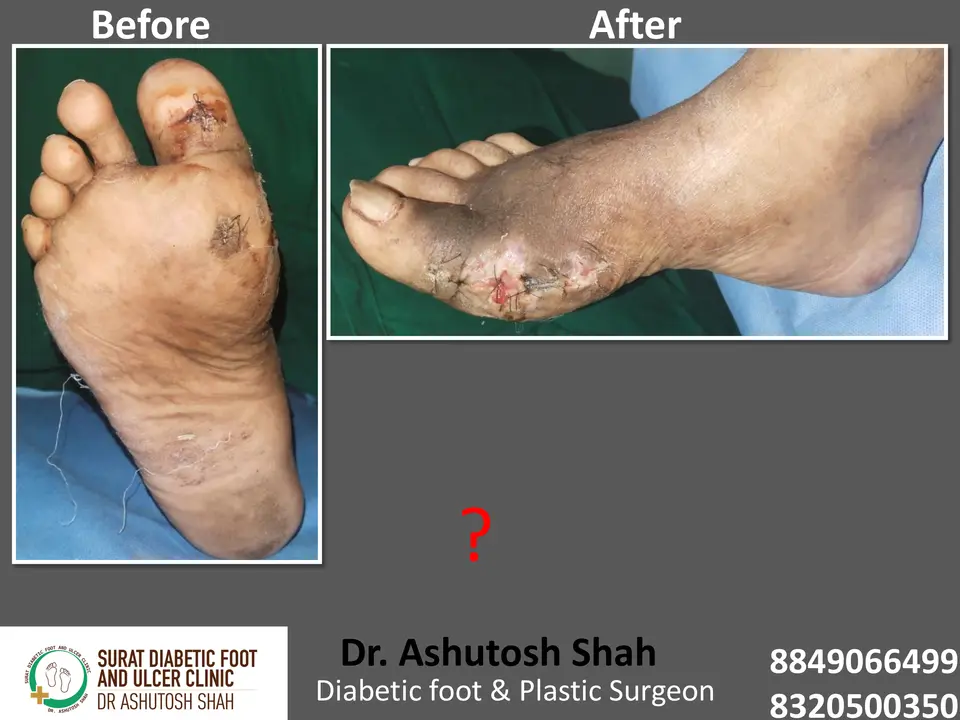 Diabetic Foot  PPT sunita.pptx-30.webp